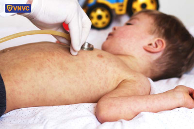 Bệnh sởi, nguyên nhân, dấu hiệu và cách phòng bệnh